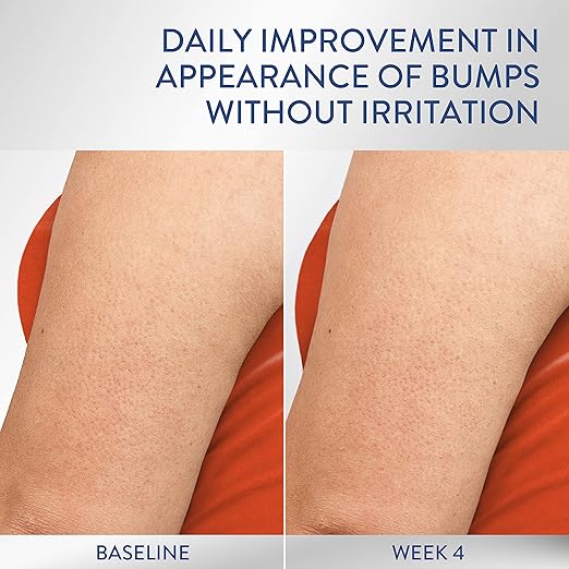 Cetaphil Rough & Bumpy Skin Daily Smoothing Moisturizer, 296ml